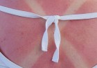 coup-de-soleil coup-de-soleil